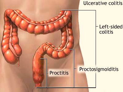 What Is Ulcerative Colitis?